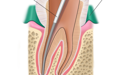 Root Canal Treatment Common Myths: Exposing and Demolishing the Falsehoods