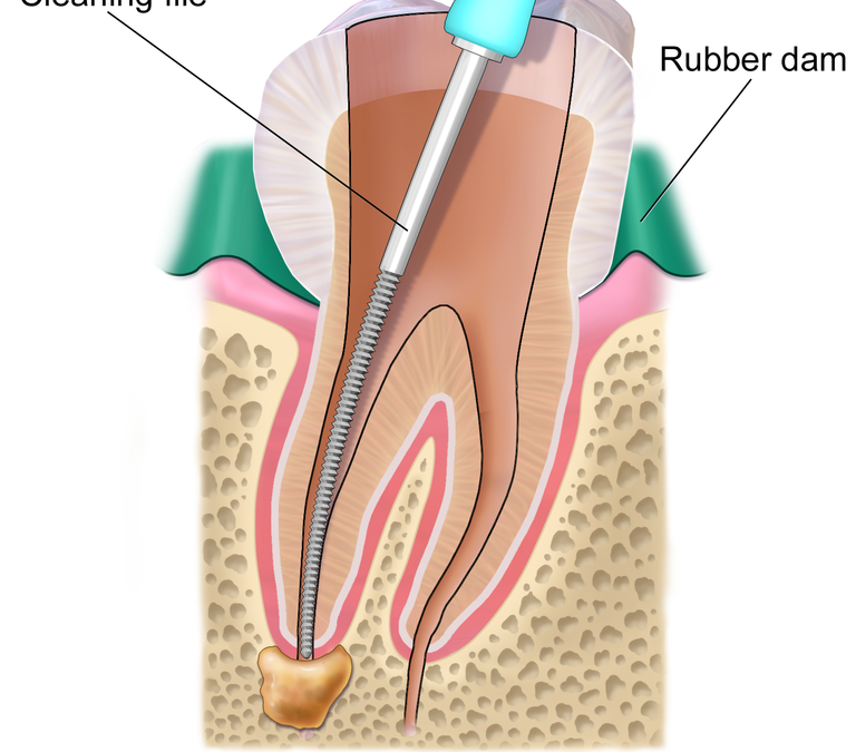 Root Canal Treatment Common Myths: Exposing and Demolishing the Falsehoods